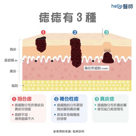 痣多的原因